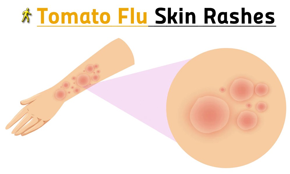 Tomato flu rashes