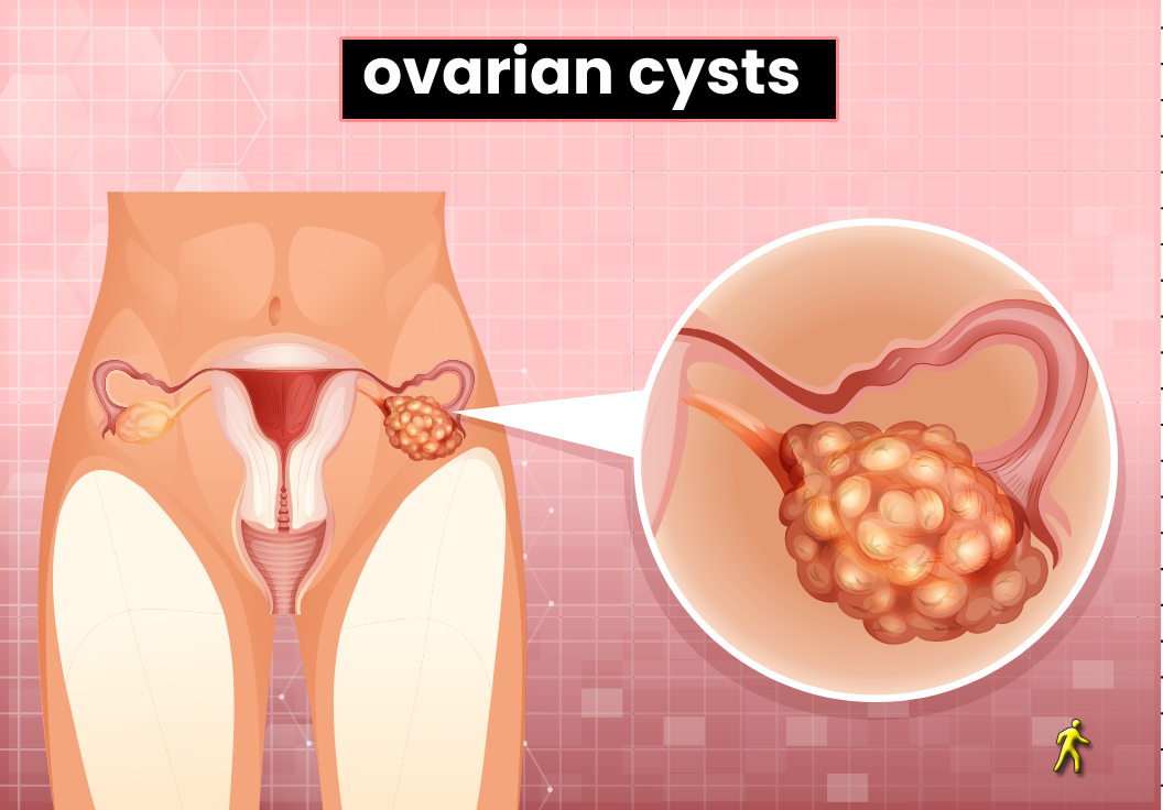ayurvedic treatment for ovarian cyst